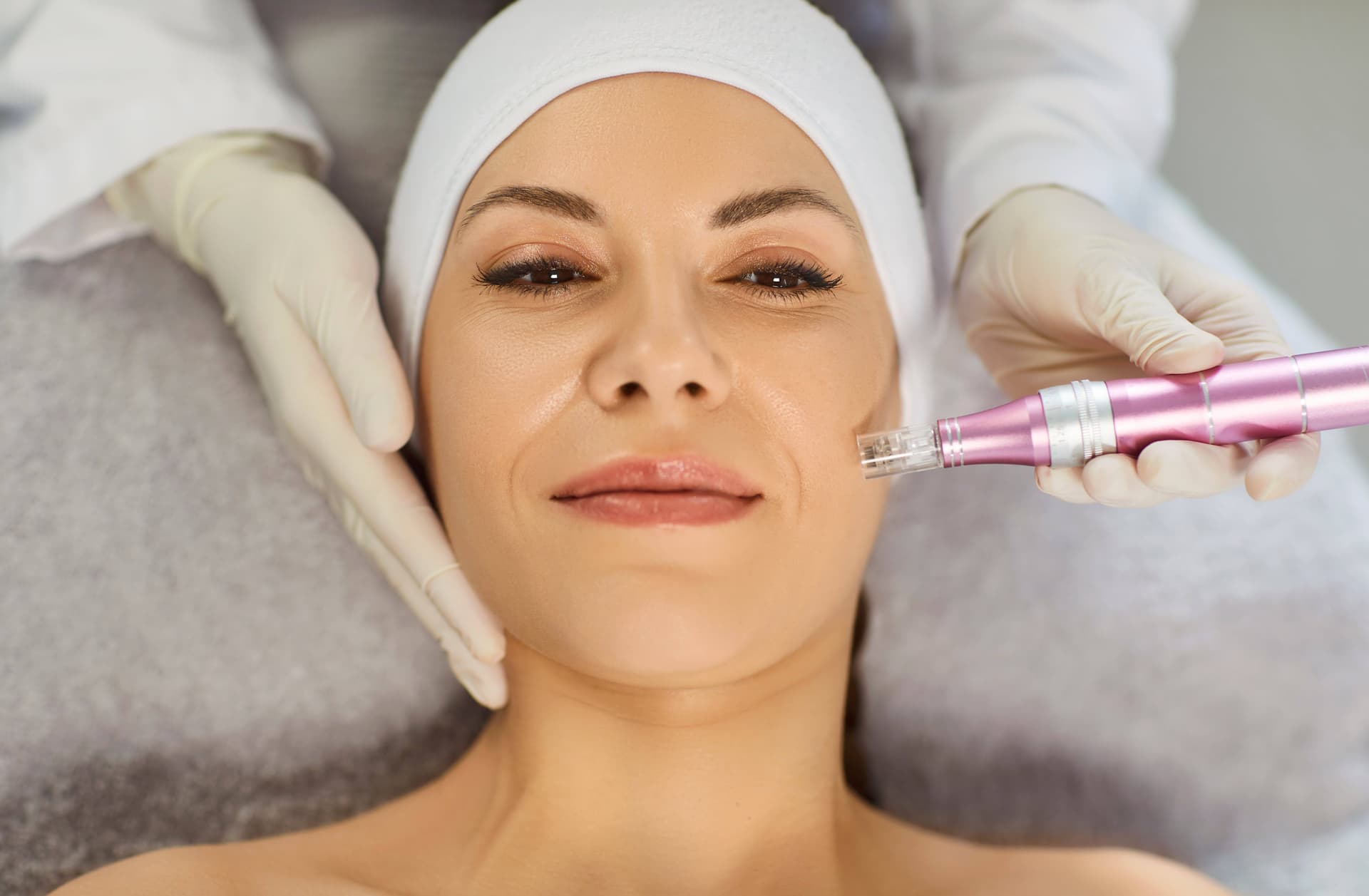 Microneedling Behandlung