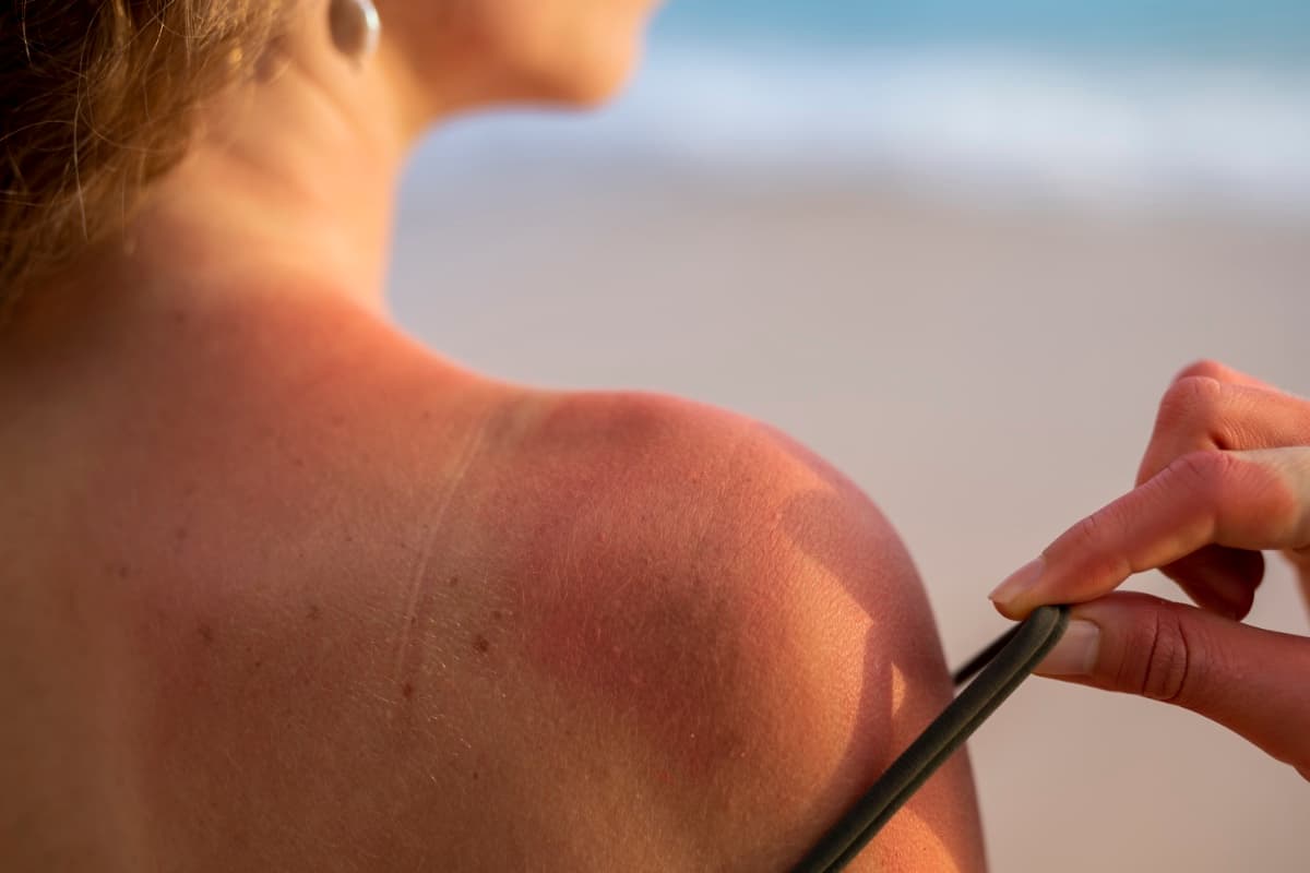 Sonnenverbrannte Schulter mit heller Bräunungslinie am Strand