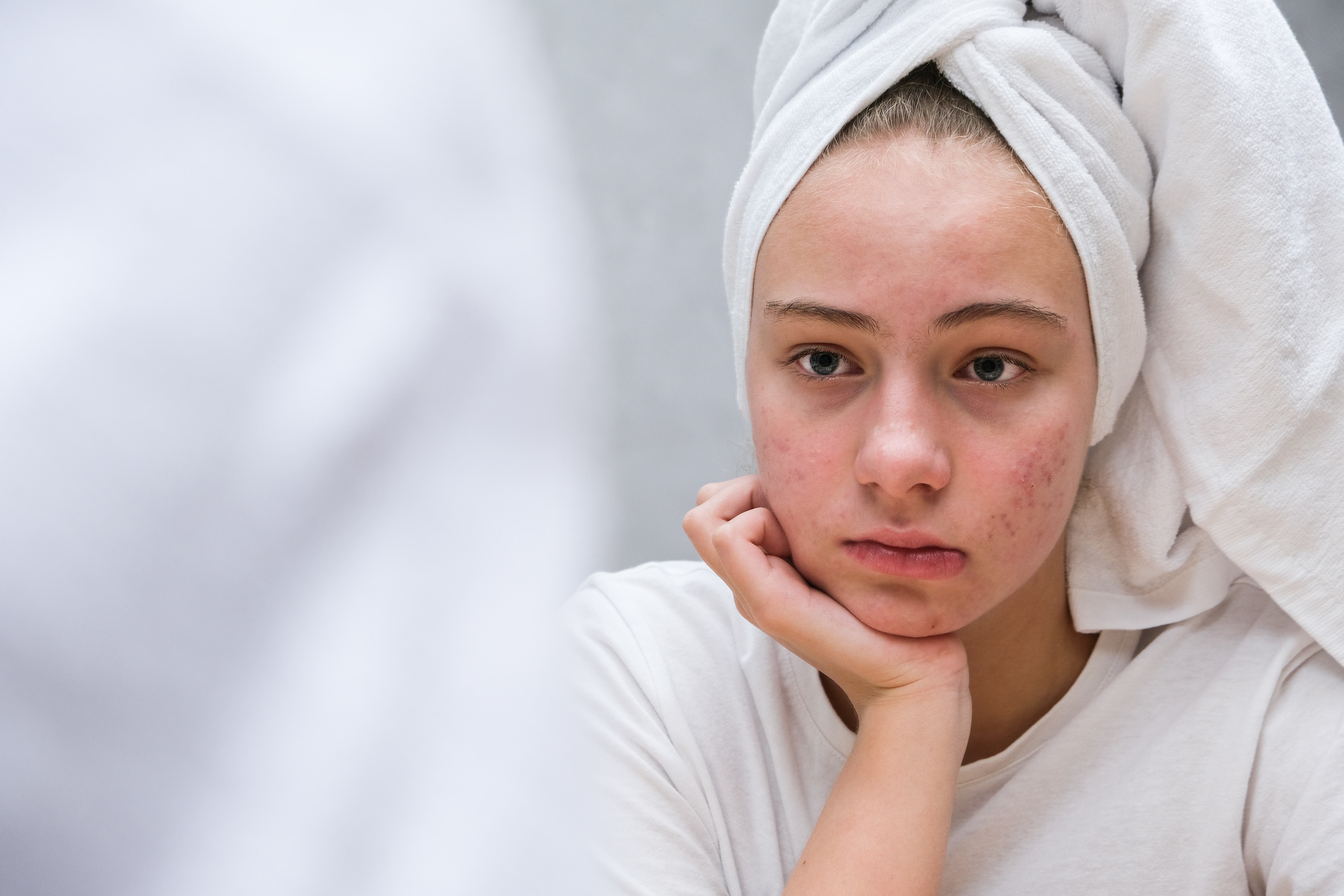 Teenager mit Hautproblemen